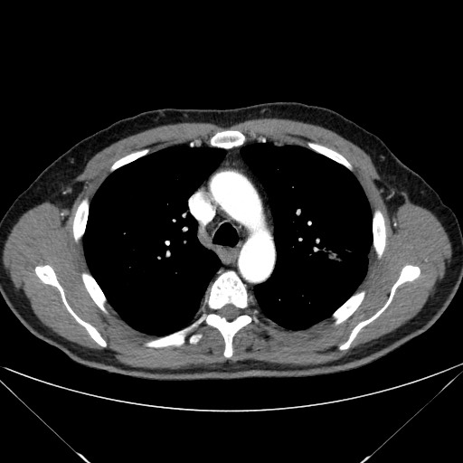 File:Adenocarcinoma of the lung (Radiopaedia 59871-67325 Axial C+ arterial phase 30).jpg
