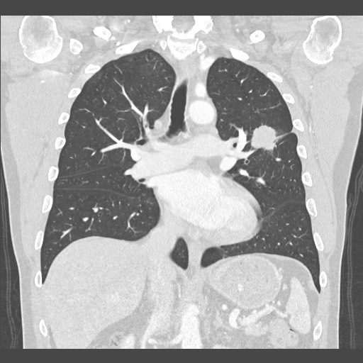 Adenocarcinoma of the lung (Radiopaedia 59871-67325 Coronal lung window 30).jpg