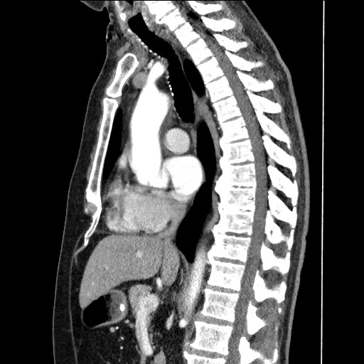 Adenocarcinoma of the lung (Radiopaedia 59871-67325 Sagittal C+ arterial phase 50).jpg