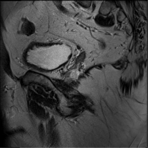 File:Adenocarcioma of rectum- T1 lesion (Radiopaedia 36921-38546 Sagittal T2 6).png