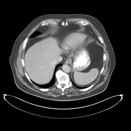 File:Adenocarcioma of rectum- T1 lesion (Radiopaedia 36921-38547 Axial C+ portal venous phase 14).png