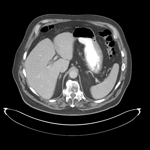 Adenocarcioma of rectum- T1 lesion (Radiopaedia 36921-38547 Axial C+ portal venous phase 22).png