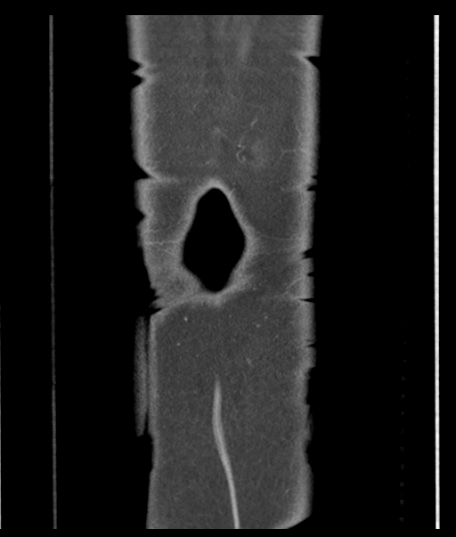 Adenocarcioma of rectum- T1 lesion (Radiopaedia 36921-38547 Coronal C+ portal venous phase 63).png