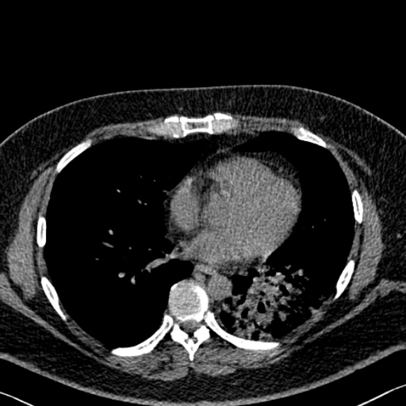 Adenoid cystic carcinoma of the trachea (Radiopaedia 49042-54137 Axial non-contrast 211).jpg
