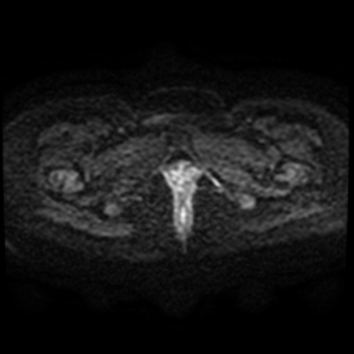 Adenoma malignum of cervix (Radiopaedia 66441-75705 Axial DWI 75).jpg