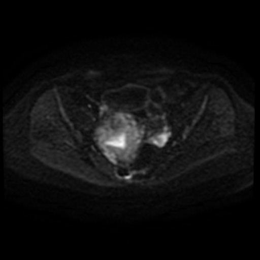 Adenoma malignum of cervix (Radiopaedia 66441-75705 Axial DWI 84).jpg