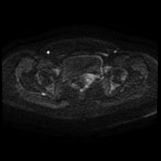 Adenoma malignum of cervix (Radiopaedia 66441-75705 Axial DWI 93).jpg