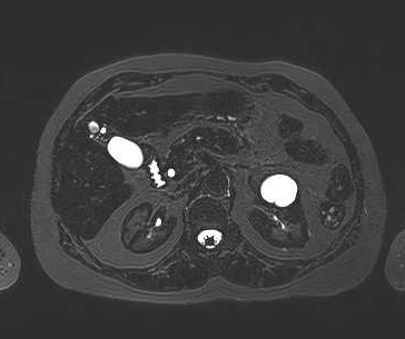 File:Adenomyomatosis of the gallbladder (Radiopaedia 50246-55587 Axial 46).png
