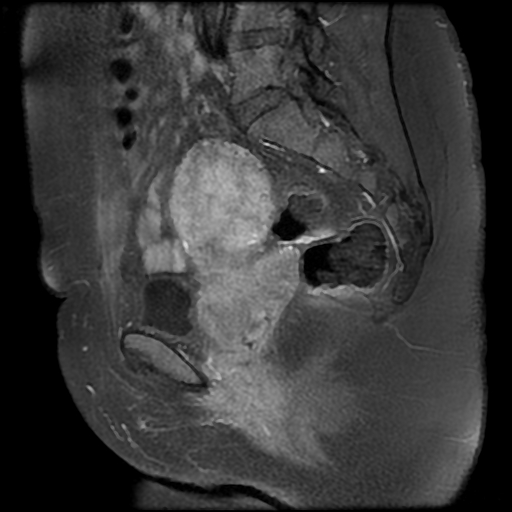File:Adenomyosis-scar endometriosis (Radiopaedia 65863-75022 Sagittal T1 C+ fat sat 11).jpg