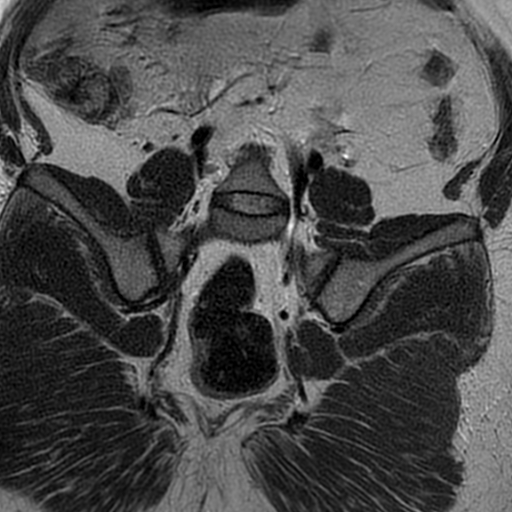 File:Adenomyosis within a didelphys uterus (Radiopaedia 70175-80215 Coronal T2 30).jpg