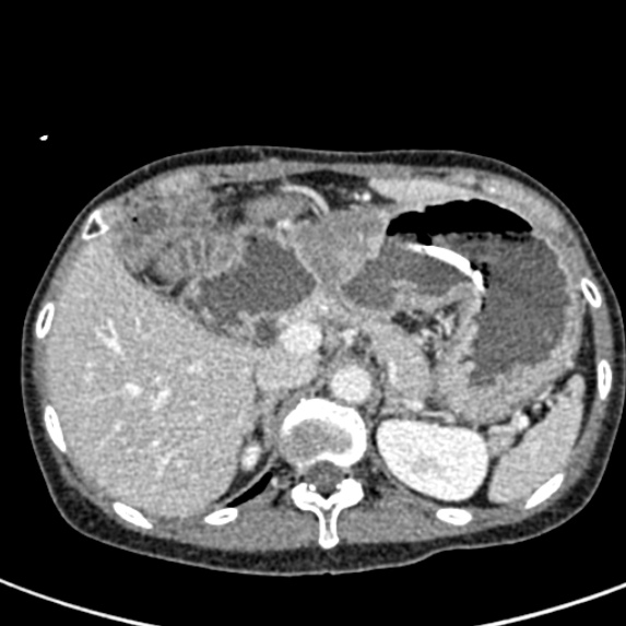 Adhesional small bowel obstruction (Radiopaedia 48397-53305 Axial C+ portal venous phase 16).jpg