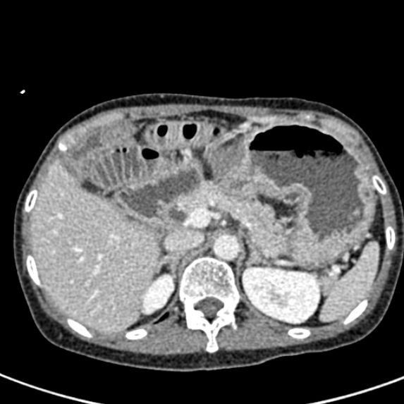 Adhesional small bowel obstruction (Radiopaedia 48397-53305 Axial C+ portal venous phase 17).jpg