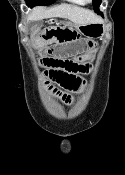 Adhesional small bowel obstruction (Radiopaedia 48397-53305 Coronal C+ portal venous phase 59).jpg