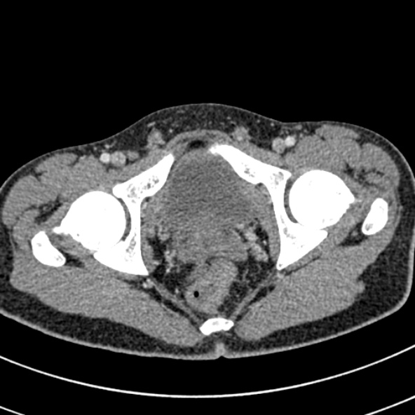 Adhesional small bowel obstruction (Radiopaedia 52107-57980 Axial C+ portal venous phase 123).jpg