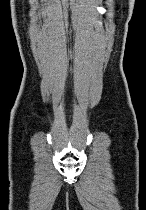 Adhesional small bowel obstruction (Radiopaedia 58900-66131 Coronal C+ portal venous phase 222).jpg