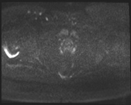 Adnexal multilocular cyst (O-RADS US 3- O-RADS MRI 3) (Radiopaedia 87426-103754 Axial DWI 82).jpg