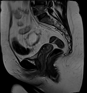 File:Adnexal multilocular cyst (O-RADS US 3- O-RADS MRI 3) (Radiopaedia 87426-103754 Sagittal T2 14).jpg