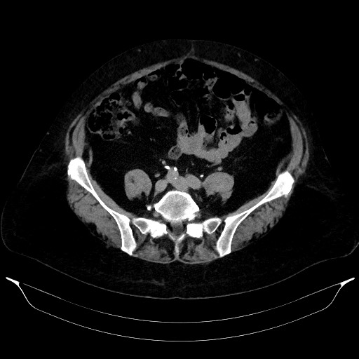 Adrenal cortical carcinoma (Radiopaedia 64017-72769 Axial C+ delayed 53).jpg