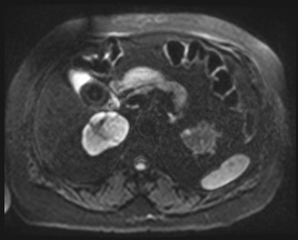 Adrenal cortical carcinoma (Radiopaedia 64017-72770 Axial DWI 59).jpg