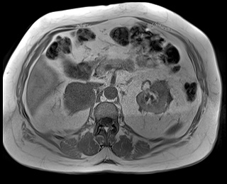 File:Adrenal cortical carcinoma (Radiopaedia 64017-72770 Axial T1 in-phase 33).jpg
