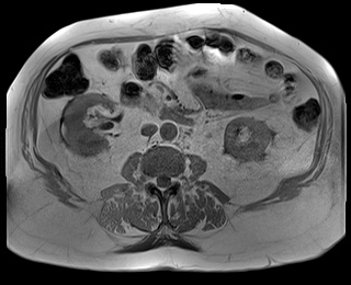 File:Adrenal cortical carcinoma (Radiopaedia 64017-72770 Axial T1 in-phase 50).jpg