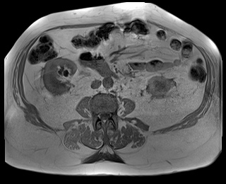 File:Adrenal cortical carcinoma (Radiopaedia 64017-72770 Axial T1 in-phase 54).jpg