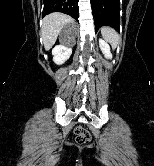Adrenal cortical carcinoma (Radiopaedia 84882-100379 Coronal C+ portal venous phase 51).jpg