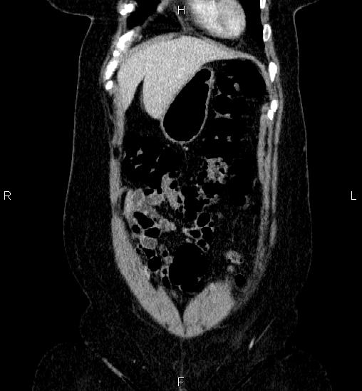 Adrenal cortical carcinoma (Radiopaedia 84882-100379 Coronal C+ portal venous phase 9).jpg
