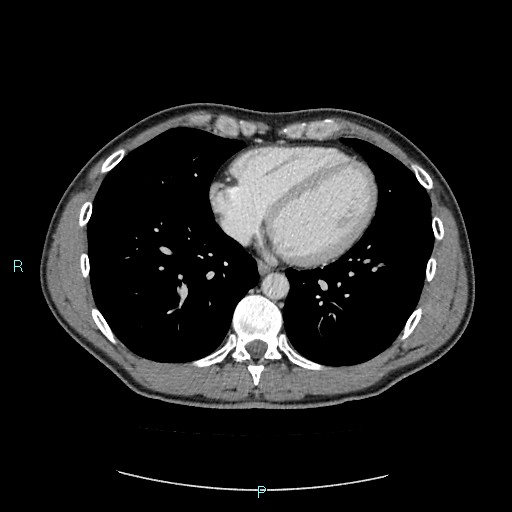 Adrenal cystic lymphangioma (Radiopaedia 83161-97534 Axial C+ portal venous phase 1).jpg