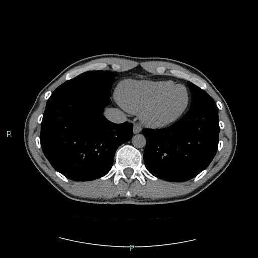 Adrenal cystic lymphangioma (Radiopaedia 83161-97534 Axial non-contrast 10).jpg