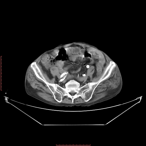 Adrenal hemangioma (Radiopaedia 68923-78668 Axial C+ arterial phase 56).jpg