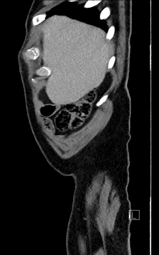 Adrenal lymphoma (Radiopaedia 73730-84529 Sagittal C+ portal venous phase 9).jpg