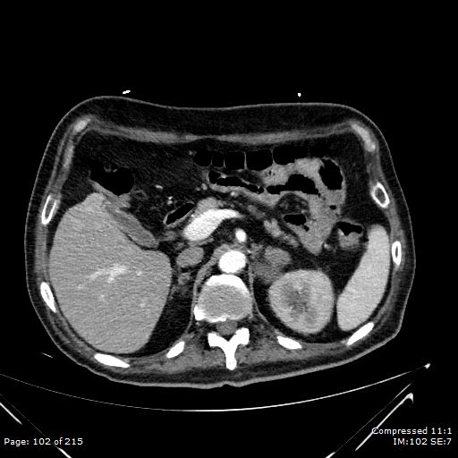 Adrenal metastasis (Radiopaedia 78425-91079 Axial C+ arterial phase 32).jpg