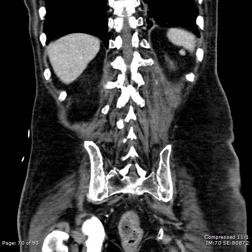 File:Adrenal metastasis (Radiopaedia 78425-91079 Sagittal C+ portal venous phase 57).jpg