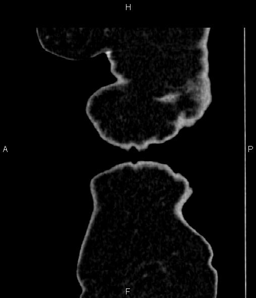Adrenal myelolipoma (Radiopaedia 82742-96986 Sagittal renal cortical phase 110).jpg