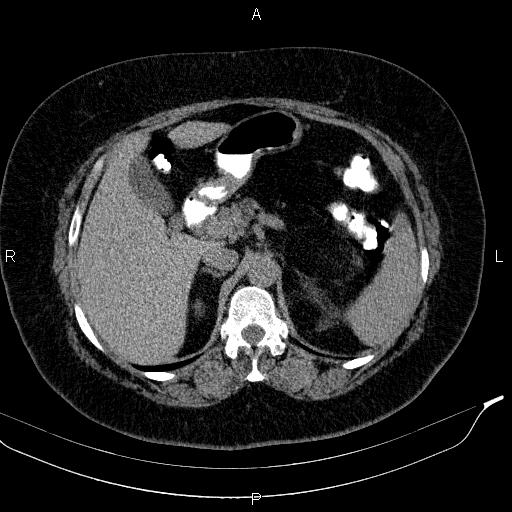 Adrenal myelolipoma (Radiopaedia 84319-99617 Axial With oral contrast 67).jpg