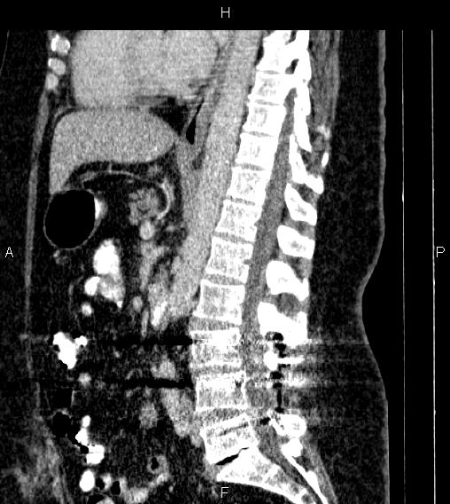 Adrenal myelolipoma (Radiopaedia 84319-99617 Sagittal renal cortical phase 50).jpg