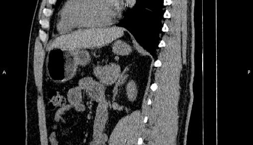 Adrenal myelolipoma (Radiopaedia 84321-99619 Sagittal non-contrast 67).jpg