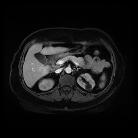 Adrenal myelolipoma - MRI (Radiopaedia 83249-97646 T1 fat sat arterial phase 36).jpg