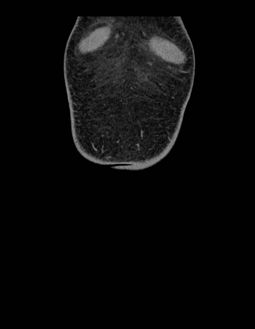 Adrenal myelolipoma - bilateral (Radiopaedia 74805-85810 Coronal C+ portal venous phase 262).jpg