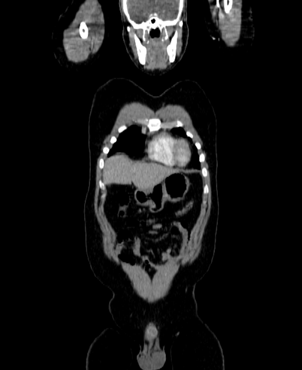 Adrenocortical carcinoma (Radiopaedia 80134-93438 Coronal C+ portal venous phase 35).jpg