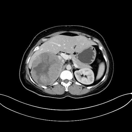 File:Adrenocortical carcinoma (Radiopaedia 87281-103569 Axial C+ portal venous phase 30).jpg