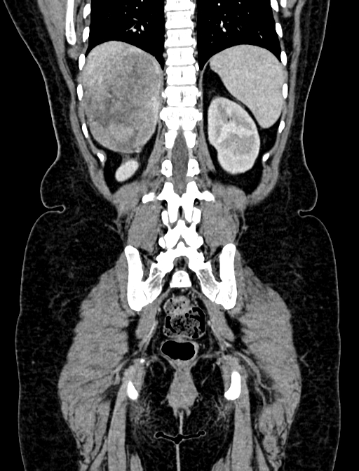 Adrenocortical carcinoma (Radiopaedia 87281-103569 Coronal C+ portal venous phase 107).jpg