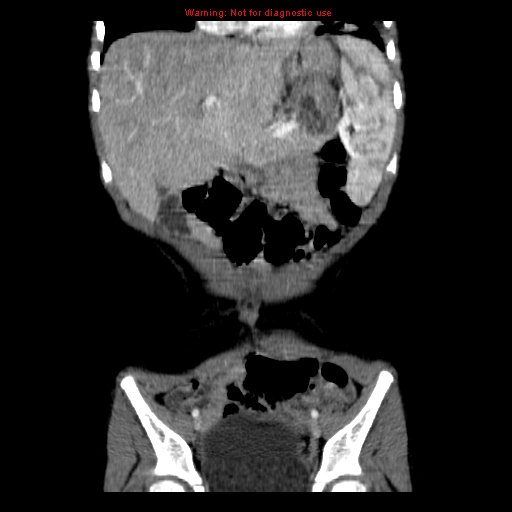 File:Adrenocortical carcinoma (Radiopaedia 9449-10131 Coronal C+ portal venous phase 1).jpg