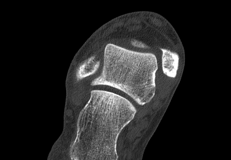 Advanced osteomyelitis due to open metatarsal fracture (Radiopaedia 83891-99095 Axial bone window 6).jpg
