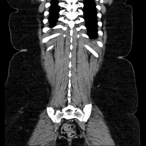 File:Afferent loop syndrome - secondary to incarcerated trocar site hernia (Radiopaedia 82959-97305 Coronal C+ portal venous phase 121).jpg