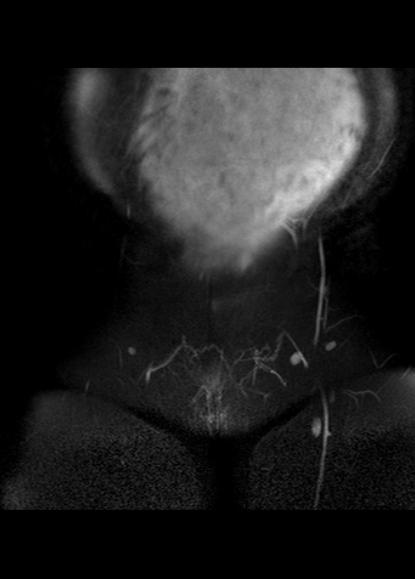 File:Aggressive angiomyxoma of the pelvis and perineum (Radiopaedia 59162-66479 Coronal T2 fat sat 2).jpg