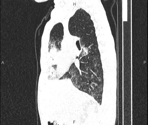 File:Air bronchogram in pneumonia (Radiopaedia 85719-101512 Sagittal lung window 40).jpg