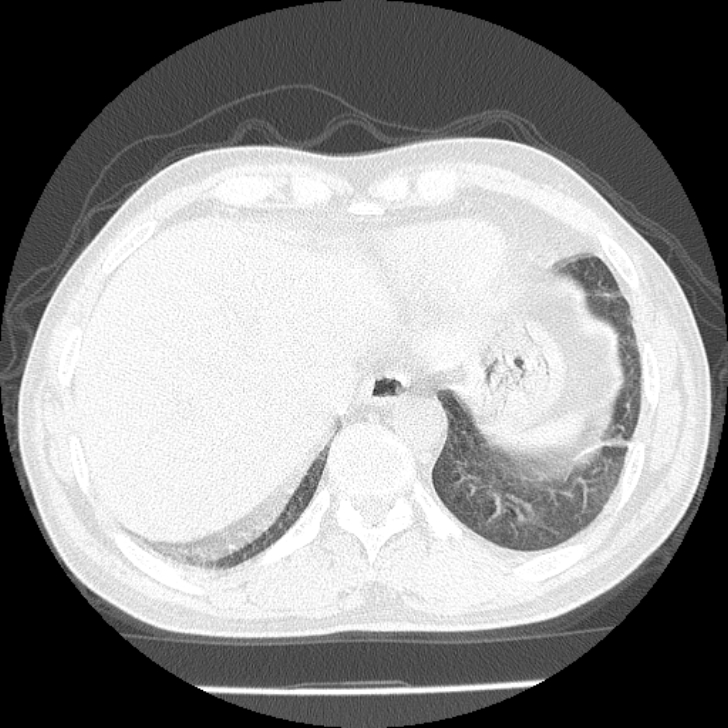 Airway foreign body in adult (Radiopaedia 85907-101779 Axial lung window 162).jpg