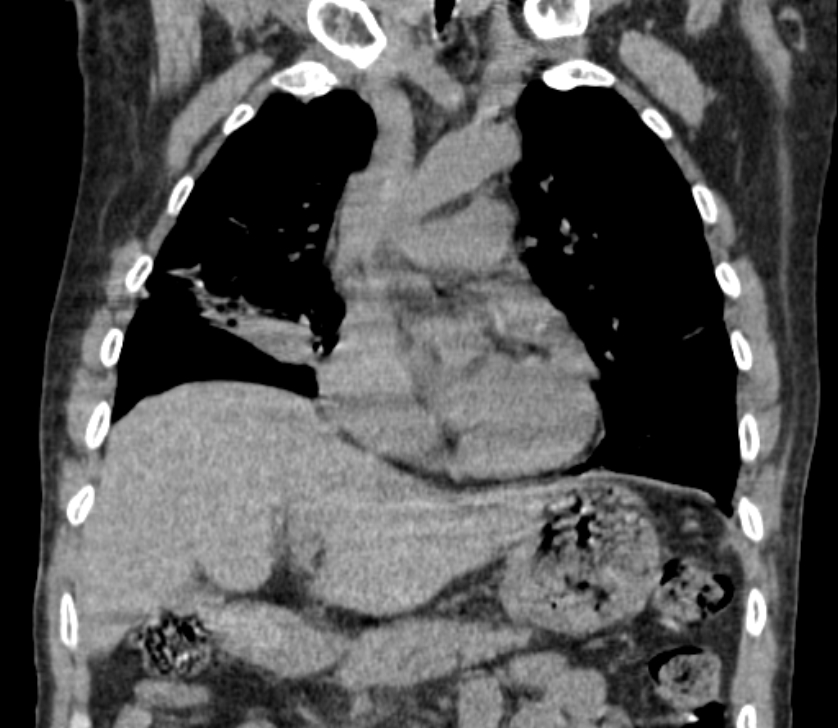Airway foreign body in adult (Radiopaedia 85907-101779 Coronal liver window 106).jpg
